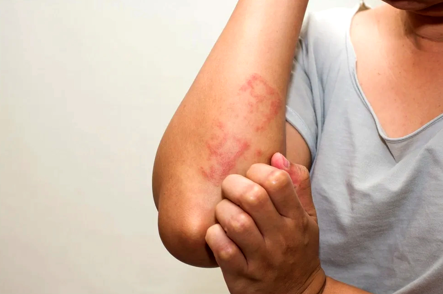 What are the of causes hives? | What are the symptoms of hives? | How long do hives last? | When to seek medical treatment for hives? | How are the hives treated and cured? | Various pictures of hives | diseases that cause hives in adults male and female | what are the Causes of hives in female adults | Can hives be a sign of something serious diseases |Various treatment of hives | How to cure hives fast and quick | Pictures of hives rash on legs and hand